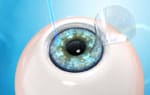 Individualized LASIK